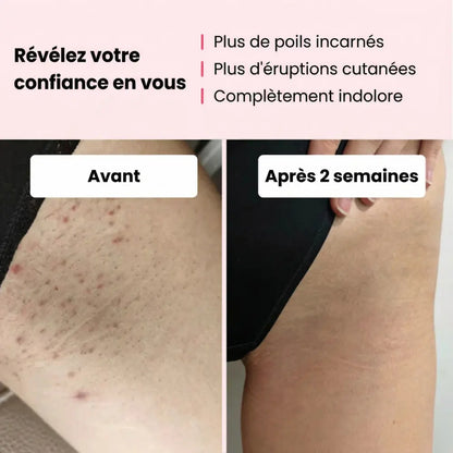 Épilateur IPL Naelyah – Appareil d’élimination des poils